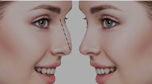 rhinoplasty